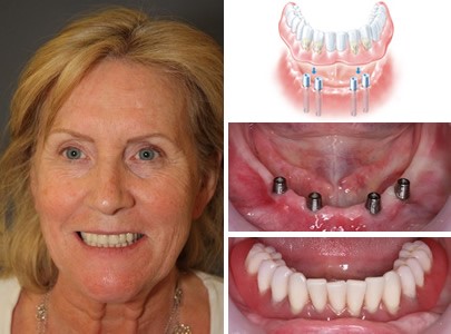 Partial Dentures For Front Teeth Port Aransas TX 78373